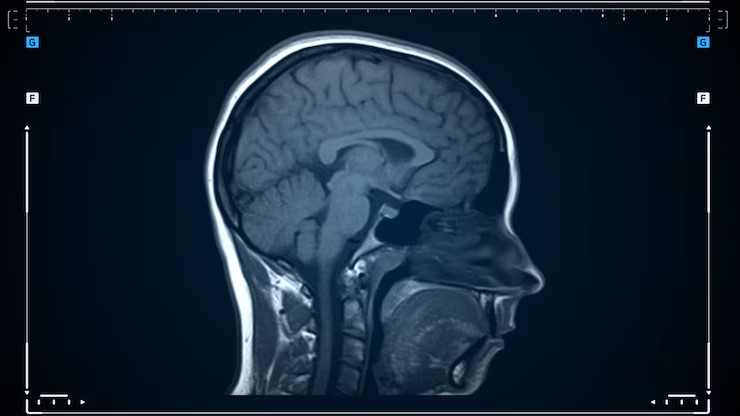 MRI scan of human brain